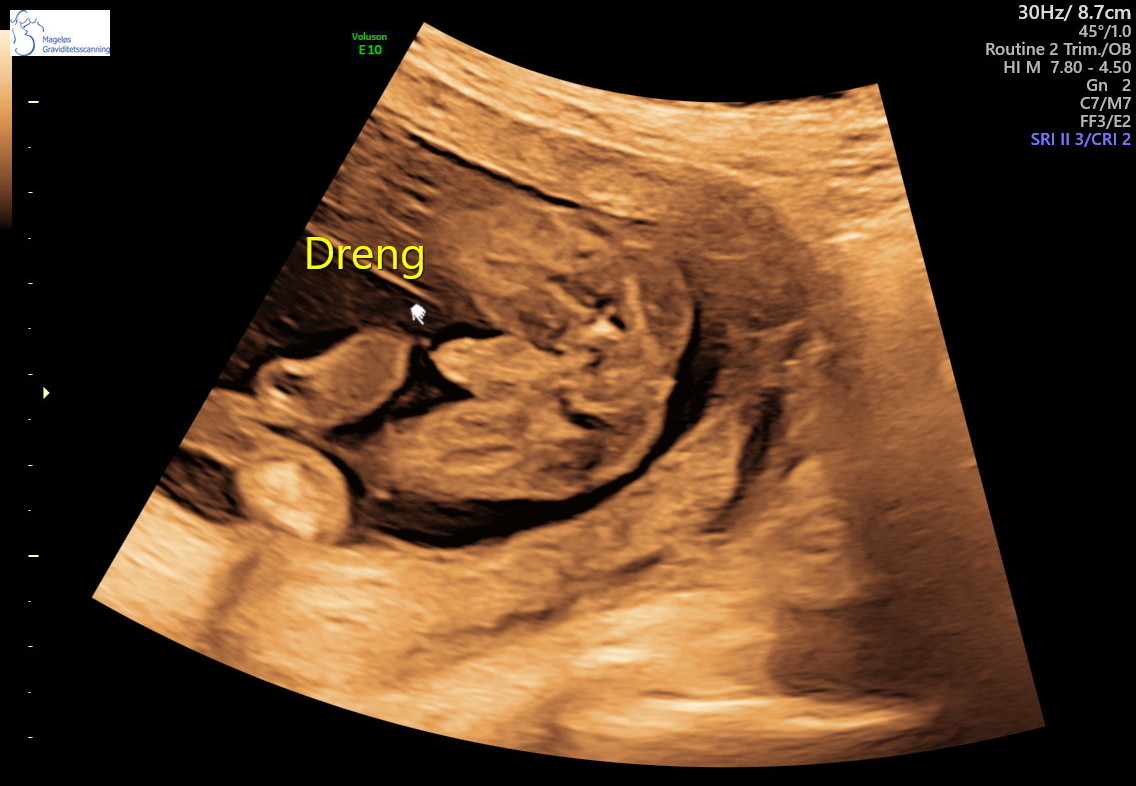 Sonograf scanner og snakker med gravid kvinde til tryghedsscanning